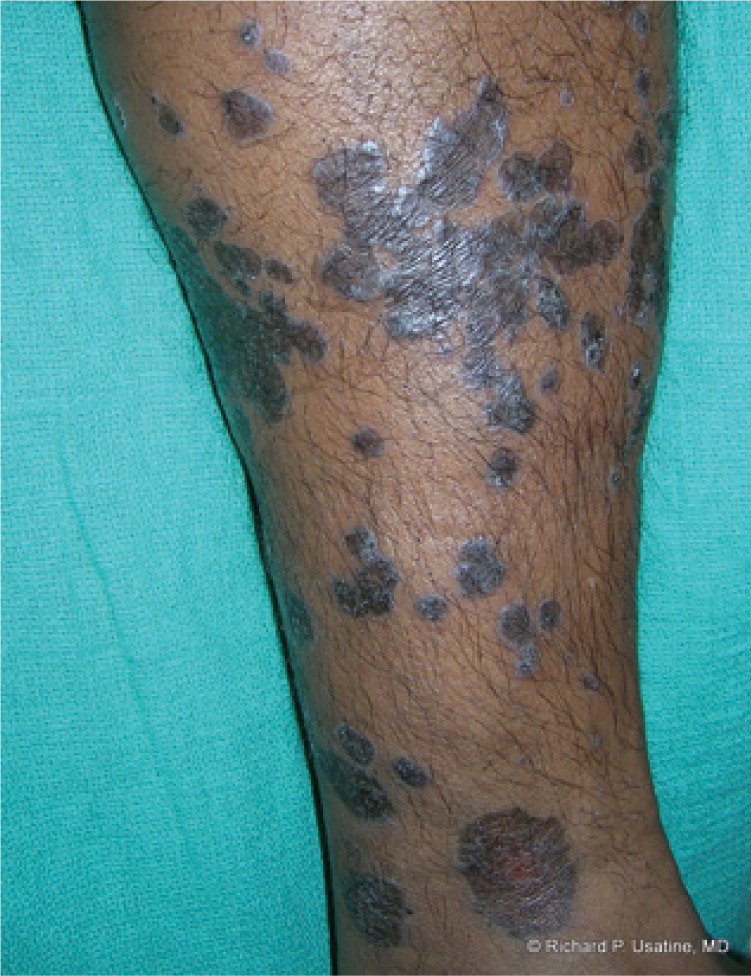 Diagnosis And Treatment Of Lichen Planus Aafp