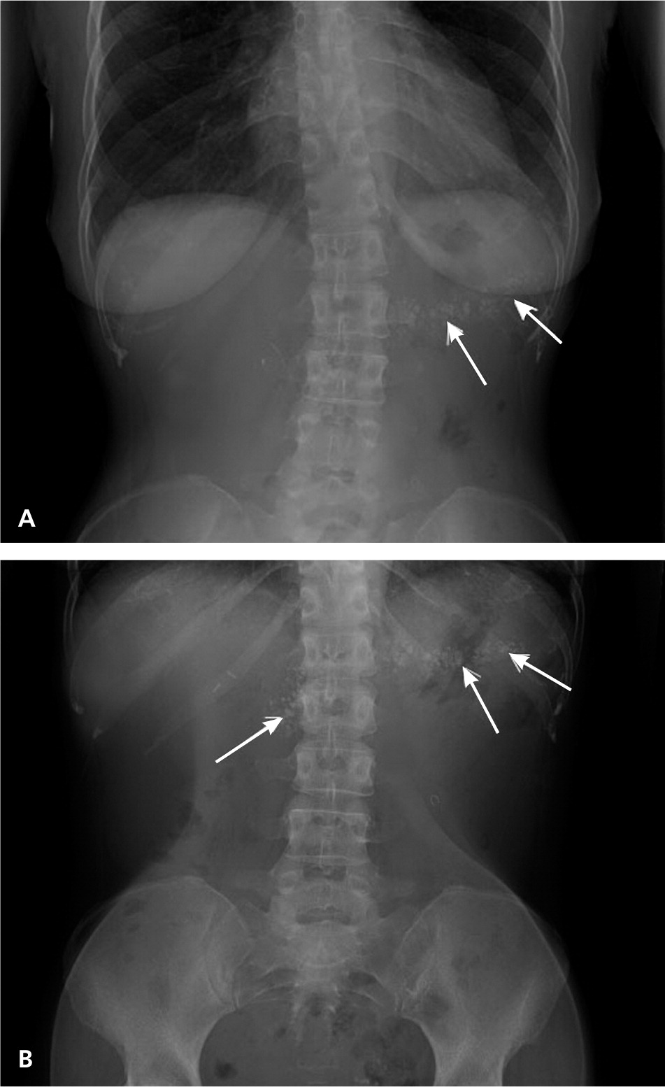 Calcifications In The Upper Abdomen Aafp