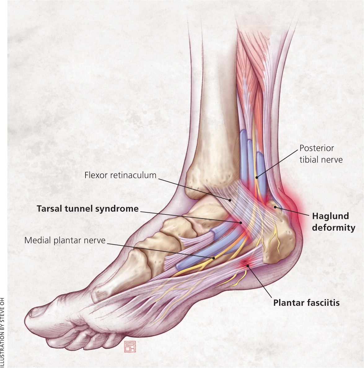 Foot Problems: Athlete's Foot, Plantar Wart, Morton's Neuroma | Podiatrist