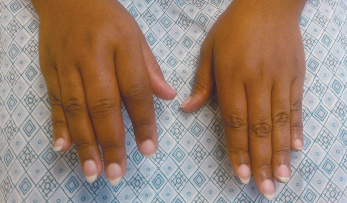 gyógyítja a kezek rheumatoid arthritisét