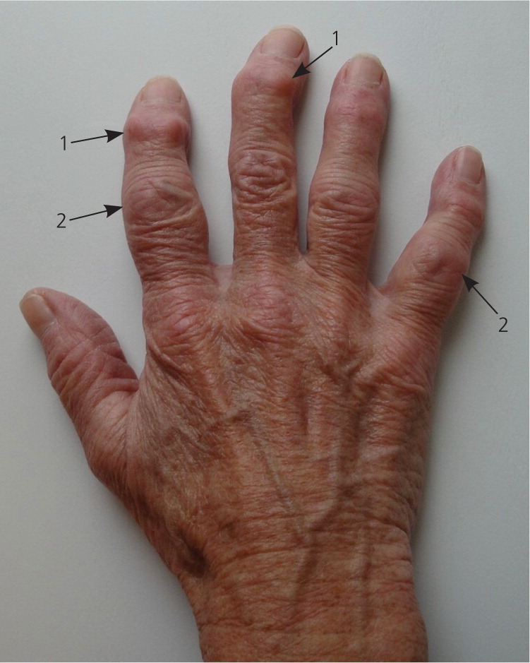 Osteoarthritis Hands