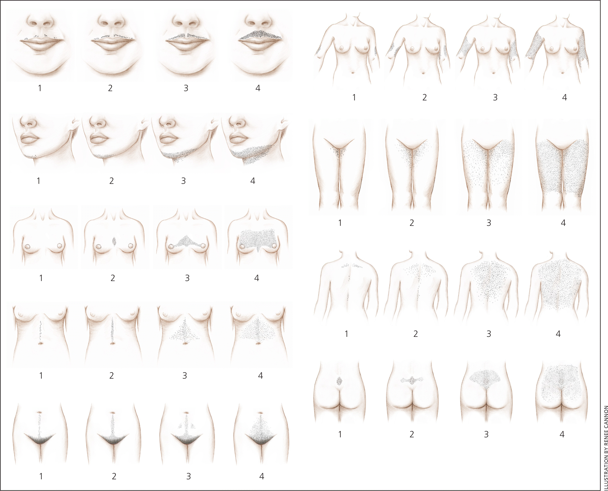 mild hirsutism in women