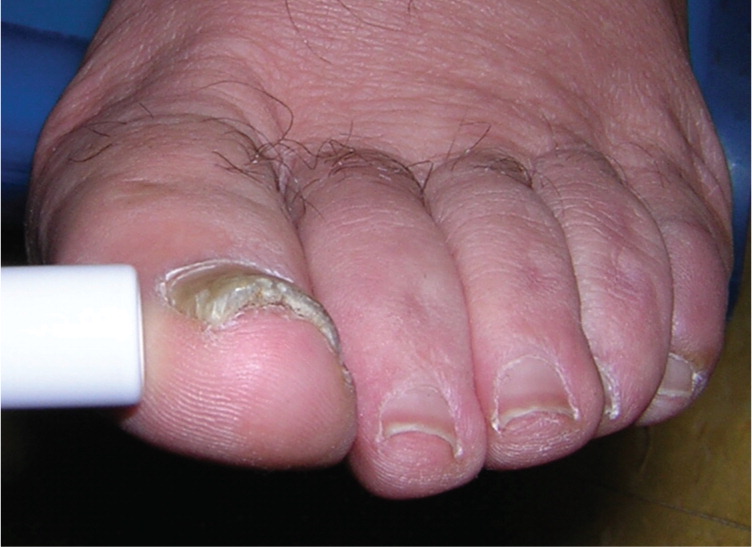 Splinter hemorrhages? (Dark lines in fingernails) | BabyCenter