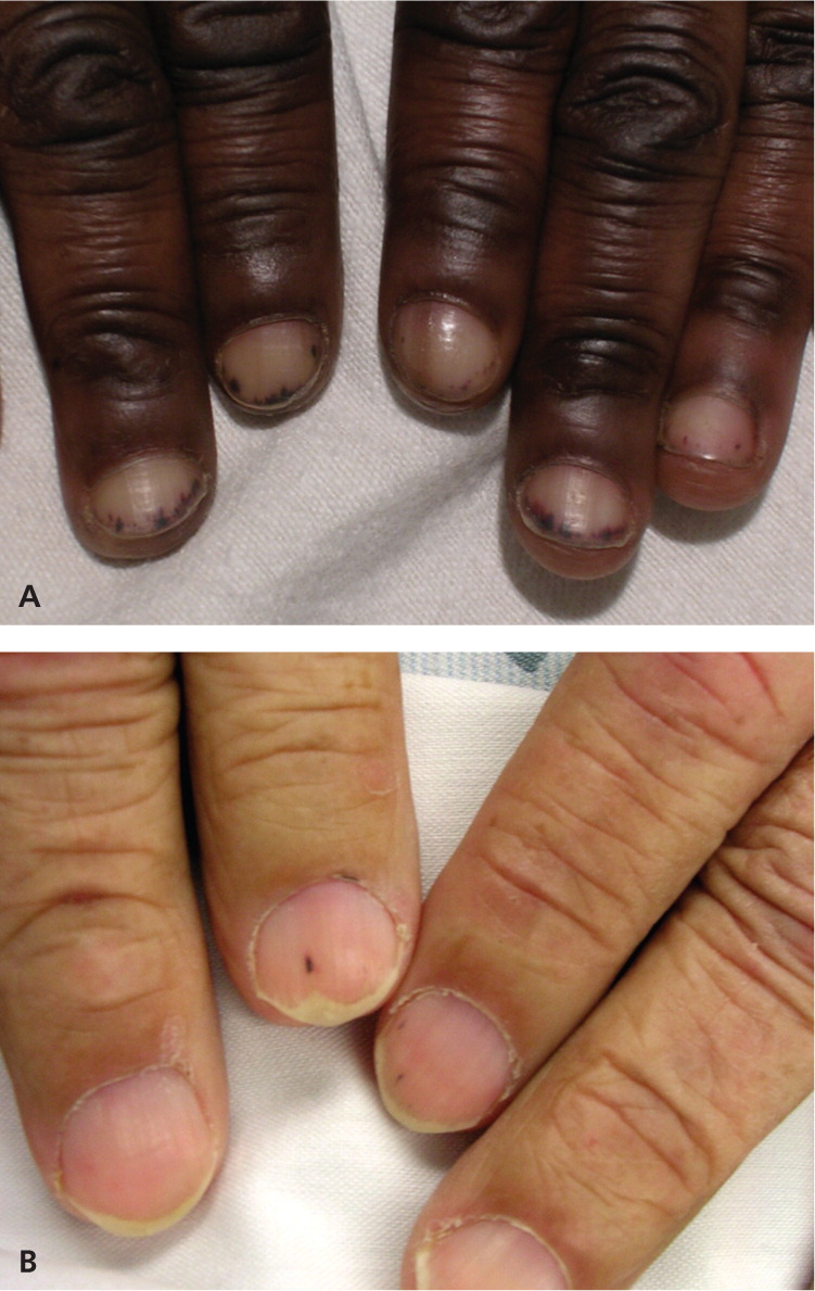 PDF) Nail Change after Chemotherapy: Simultaneous Development of Beau's  Lines and Mees' Lines