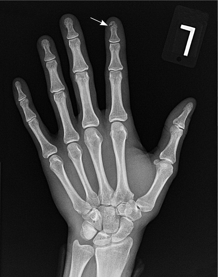 Трещина фаланги. Оскольчатый перелом рентген кисти. Периостит пальца кисти рентген. Перелом кости ногтевой фаланги. Перелом межфалангового сустава.