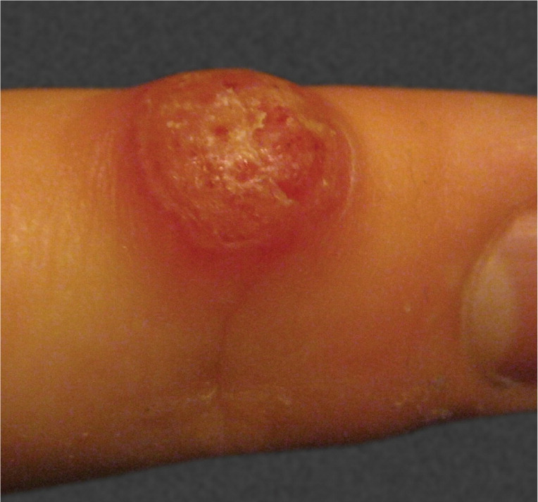 Painless, Red Nodule on the Finger of Student | AAFP