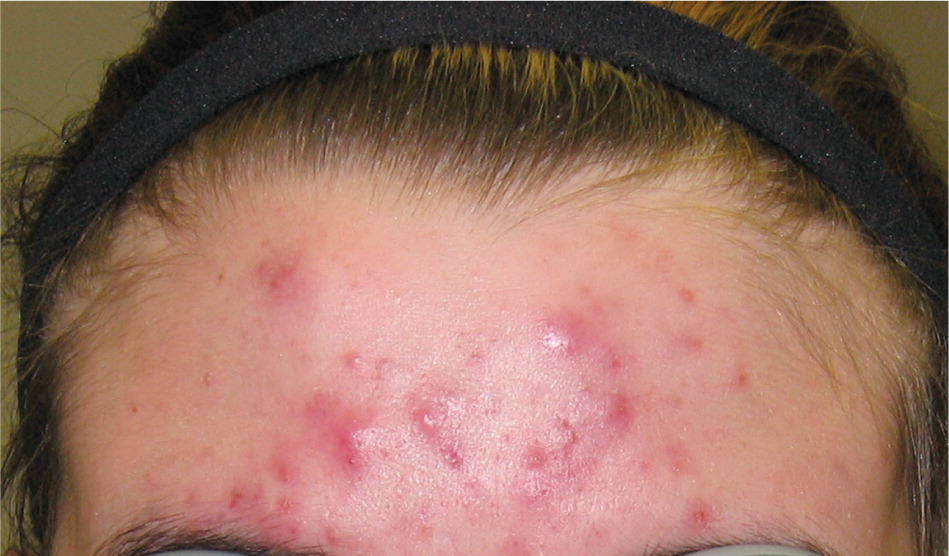 mild acne vulgaris