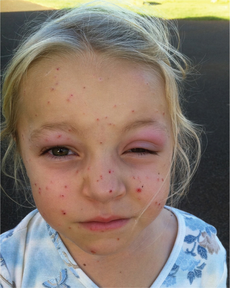 Papular Rash In A Child After A Fever Aafp