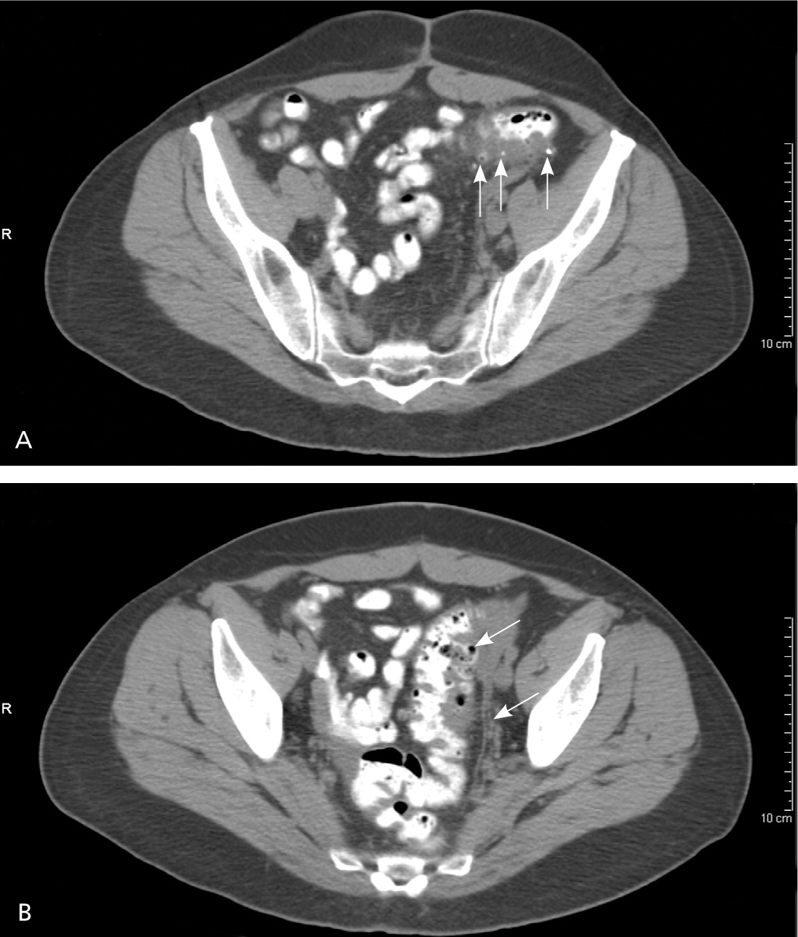Diagnosis and of Diverticulitis |