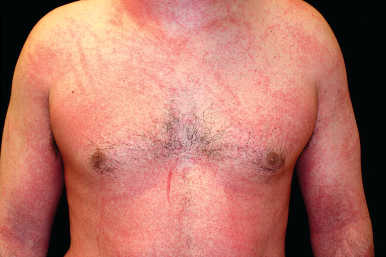 diffuse erythematous rash