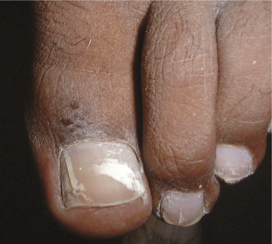 Onychomycosis: Current Trends in Diagnosis and Treatment | AAFP