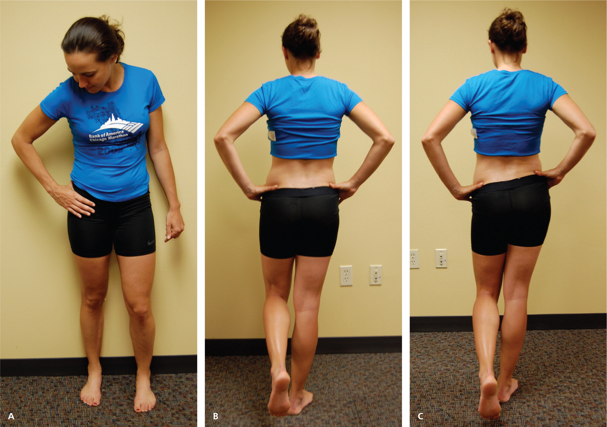 Thirty-three year-old female runner who referred right groin pain