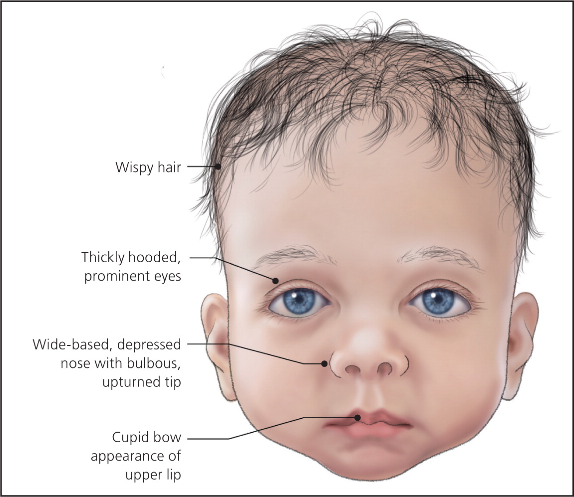 Noonan Syndrome Diagram