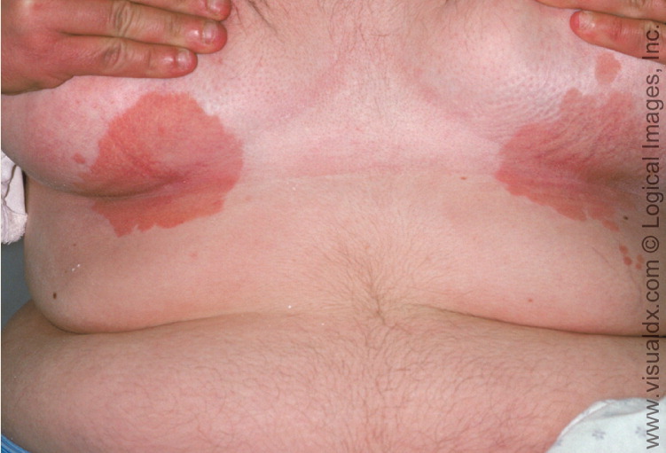 Intertrigo - dermatitis on the lower breast - Stock Image - M180