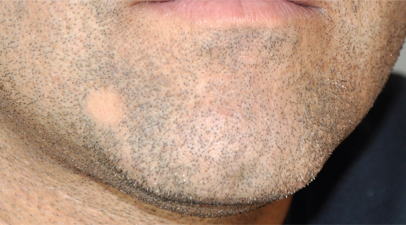 Bald Patch in the Beard  AAFP