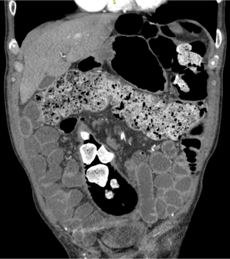 Faecal impaction with overflow