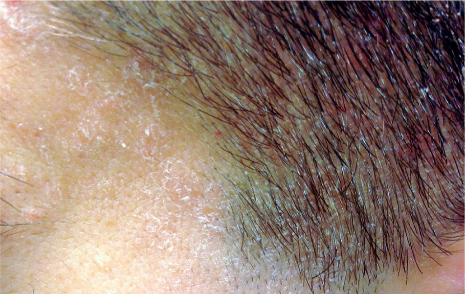 Diagnosis And Treatment Of Seborrheic Dermatitis Aafp