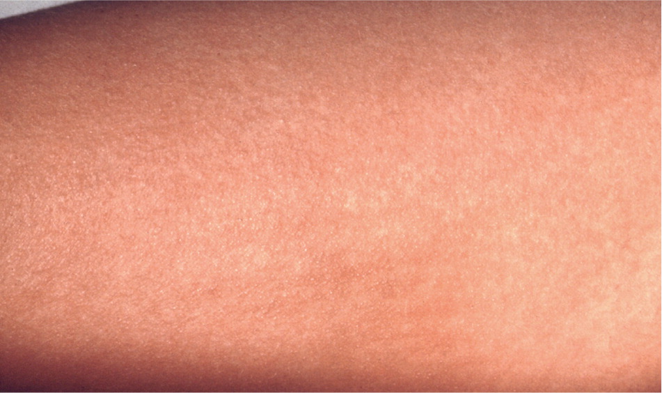 Common Skin Rashes In Children Aafp