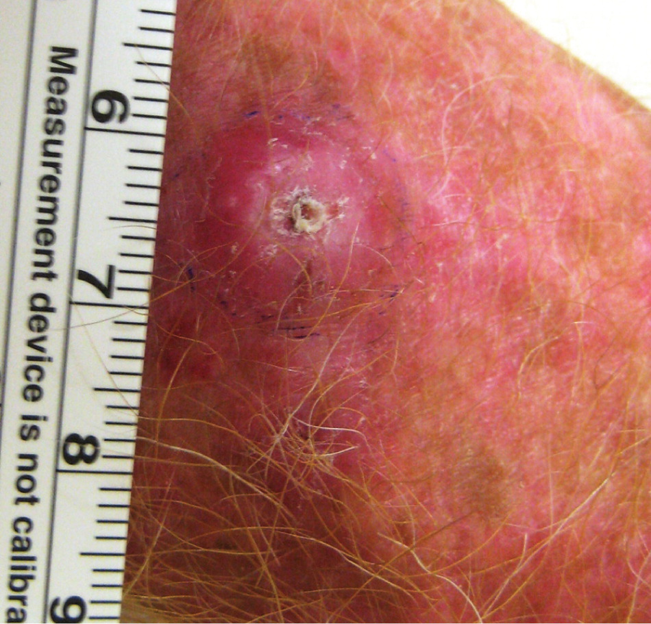 Diagnosing Common Benign Skin Tumors Aafp