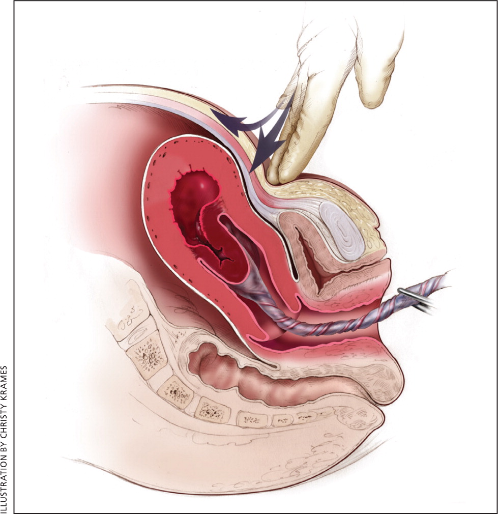 Postpartum Hemorrhage: Prevention and Treatment