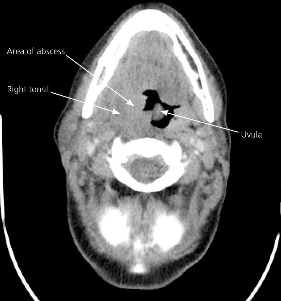 Peritonsillar Abscess Aafp