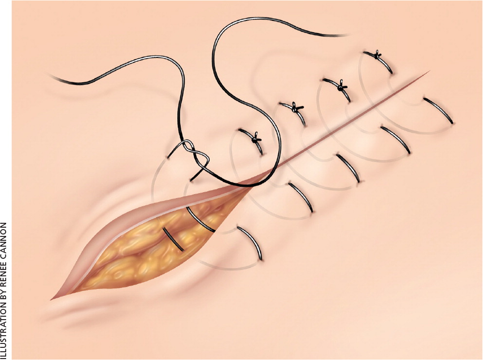 Lacerations: Does closure technique matter? - First10EM