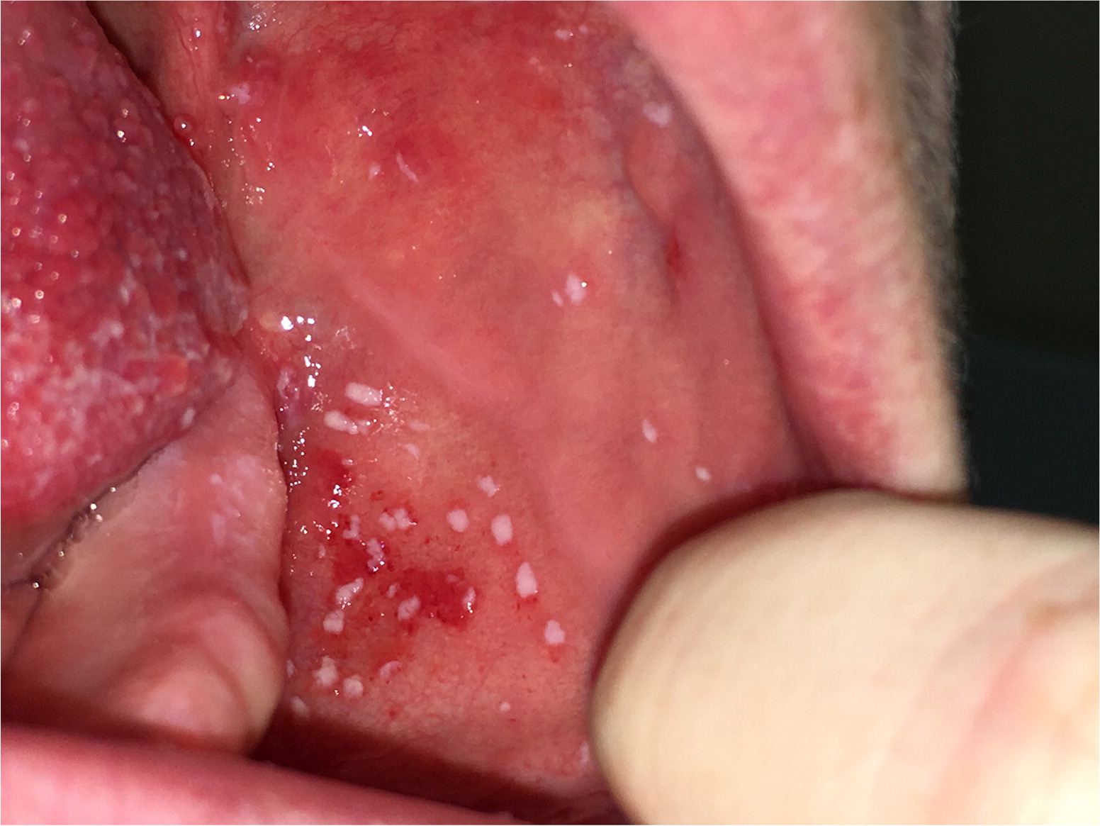 anden suffix åbning Rash Inside the Mouth | AAFP