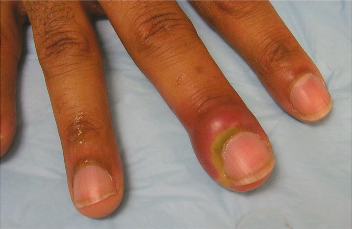 Paronychia Swollen Finger Fingernail Bed Inflammation Stock Photo 272636984  | Shutterstock