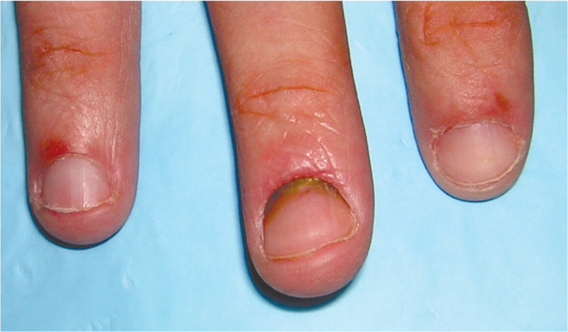 Nails of a COVID‐19 patient 16 weeks after disease diagnosis. The nails...  | Download Scientific Diagram