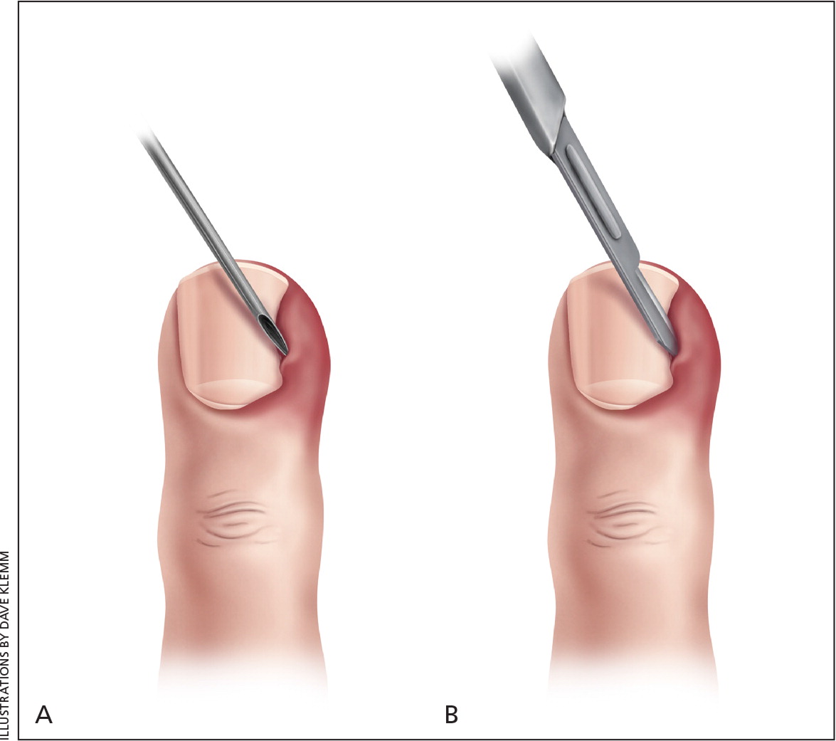 Paronychia Swollen Finger Fingernail Bed Inflammation Stock Photo  1435608734 | Shutterstock