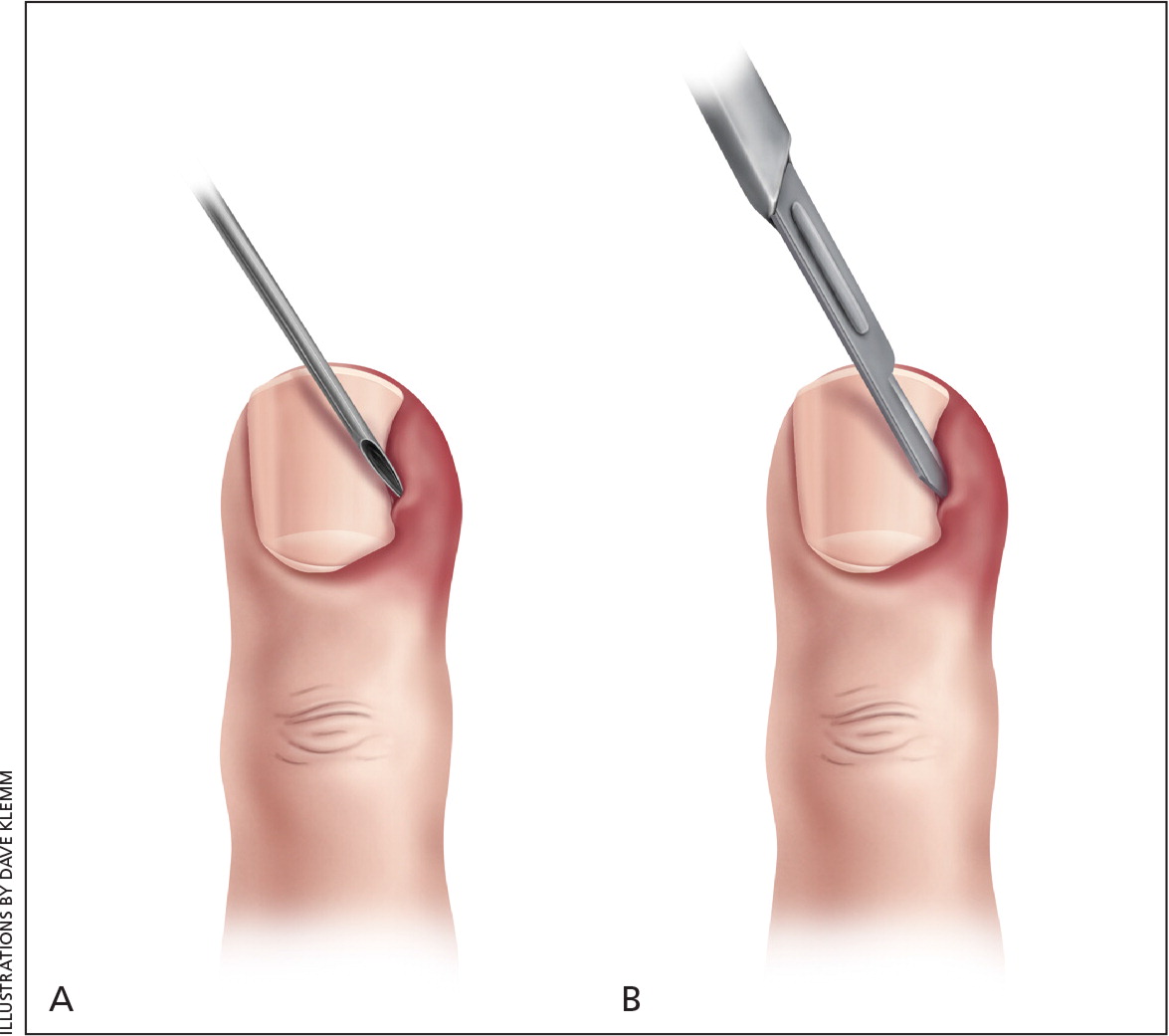 Compva: Nail bed inflammation