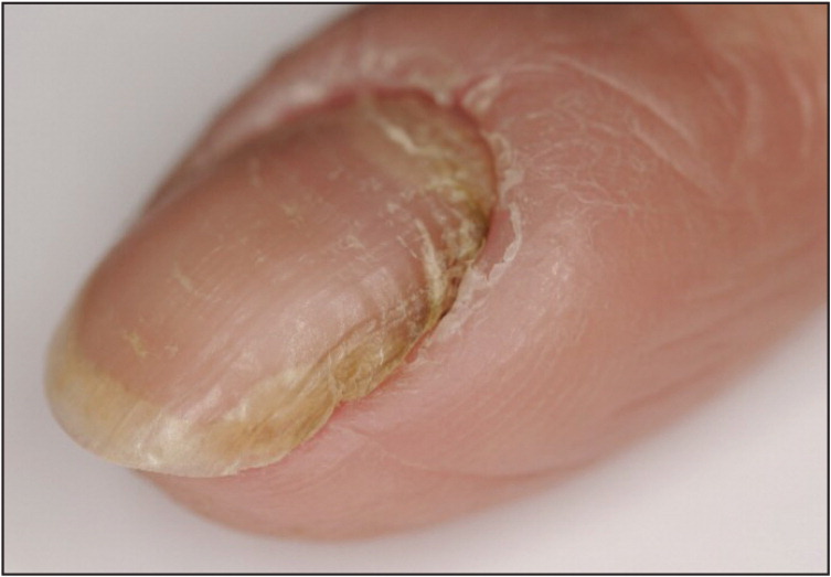 Pseudomonas bacterial nail infection - Stock Image - C049/5542 - Science  Photo Library