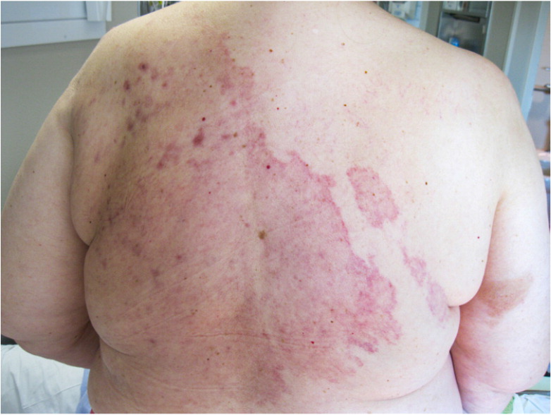 A Persistent Rash on the Back, Chest, and Abdomen