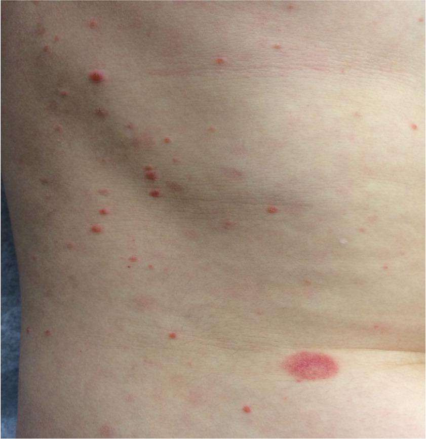 Pityriasis Rosea Diagnosis And Treatment Aafp