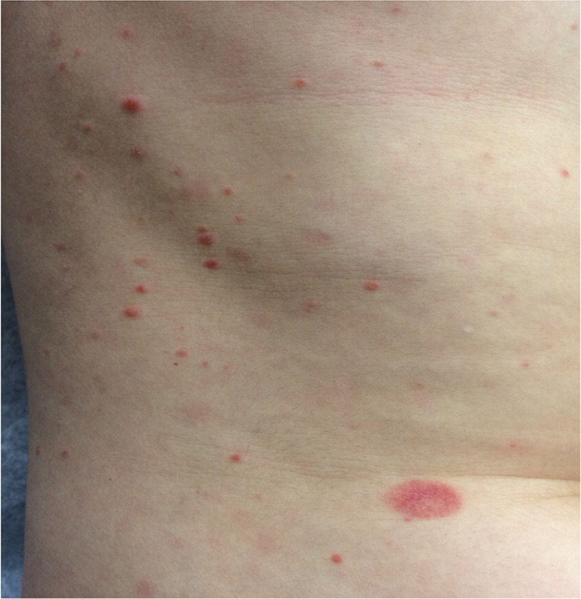 Pityriasis Rosea Condition, Treatments and Pictures for Teens