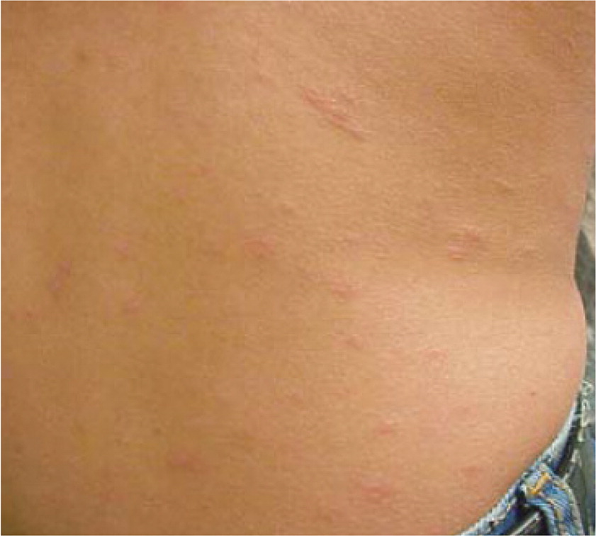 Pityriasis Rosea Treatment NYC - What is Pityriasis Rosea?