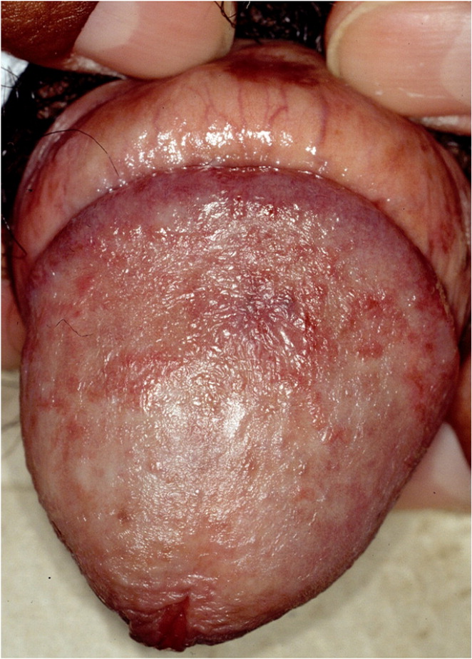 Phimosis and ischaemia of the glans penis, both clinical signs of