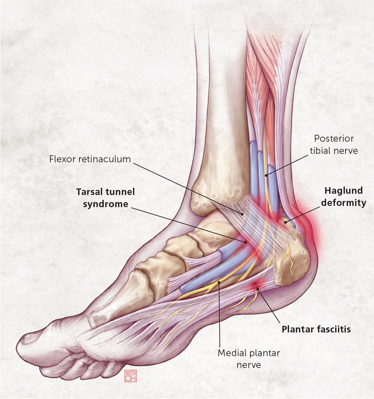 A Primary Cause of Heel Pain is Plantar Fasciitis — Fit Feet For Life