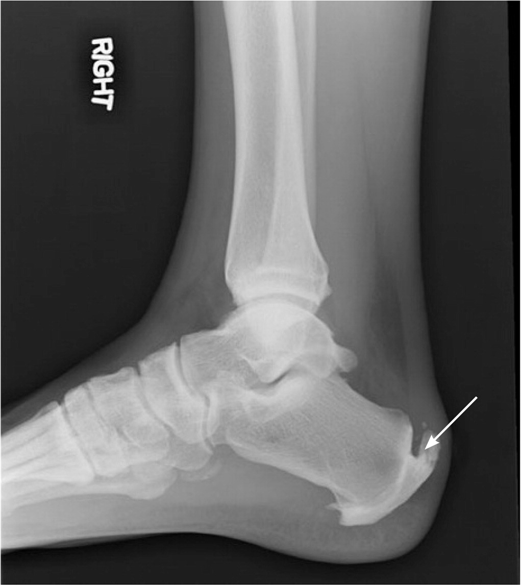 PDF) Cryoultrasound therapy in the treatment of chronic plantar fasciitis  with heel spurs, A randomized controlled clinical study