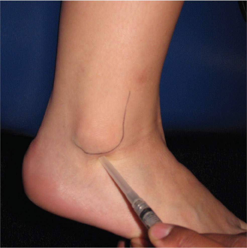 What Is Achilles Tendonitis and How Is It Treated? | The Podiatry Group of  South Texas