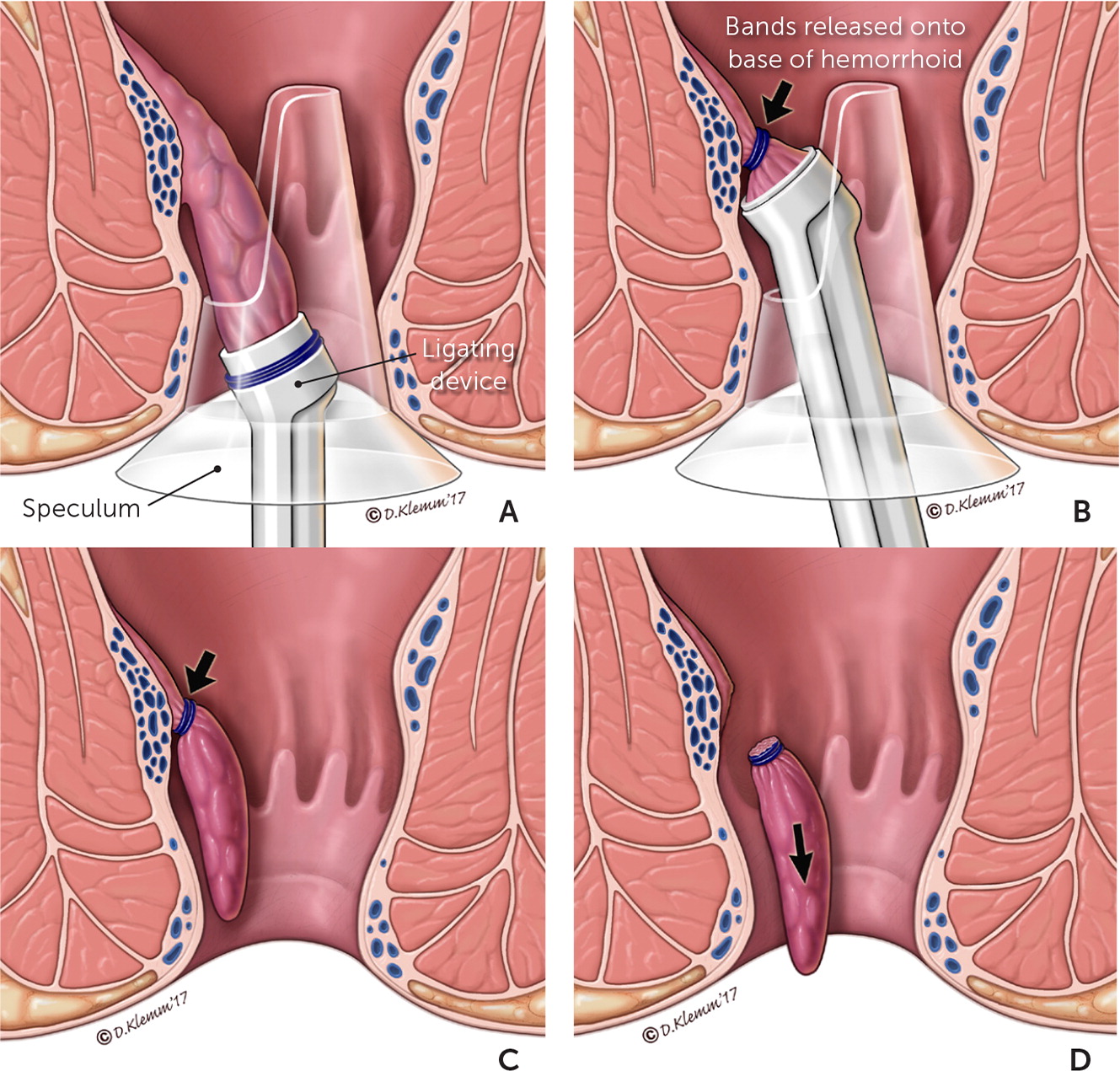 Piles treatment: What are piles and how do I get rid of them?