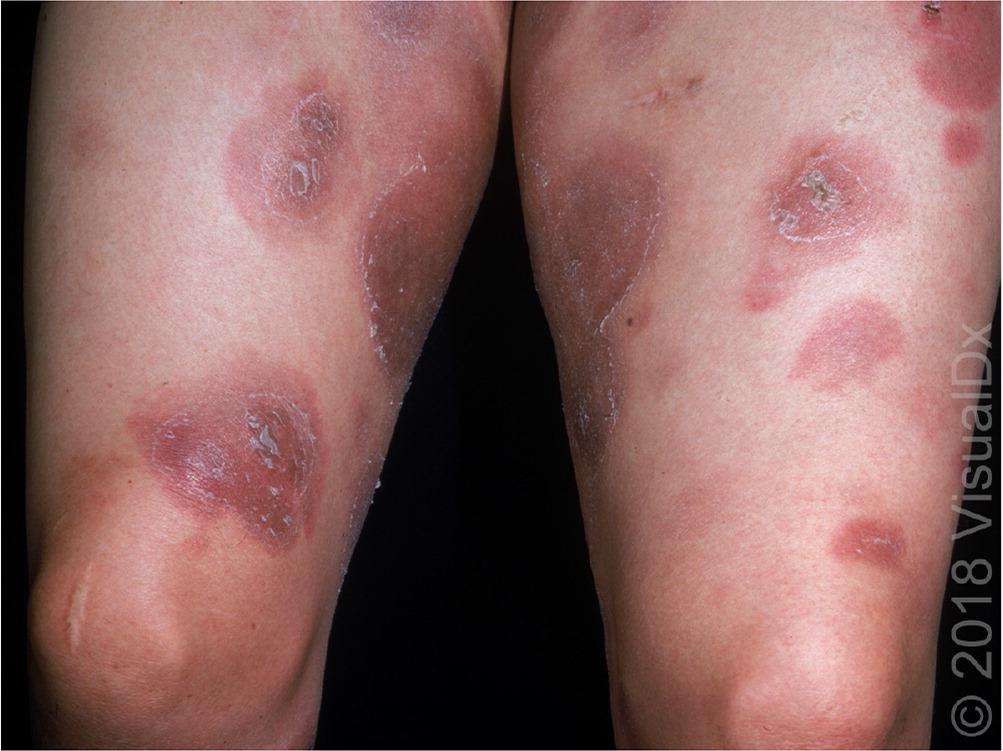 Lyme Disease Rash (Erythema Migrans): Pictures & Differences