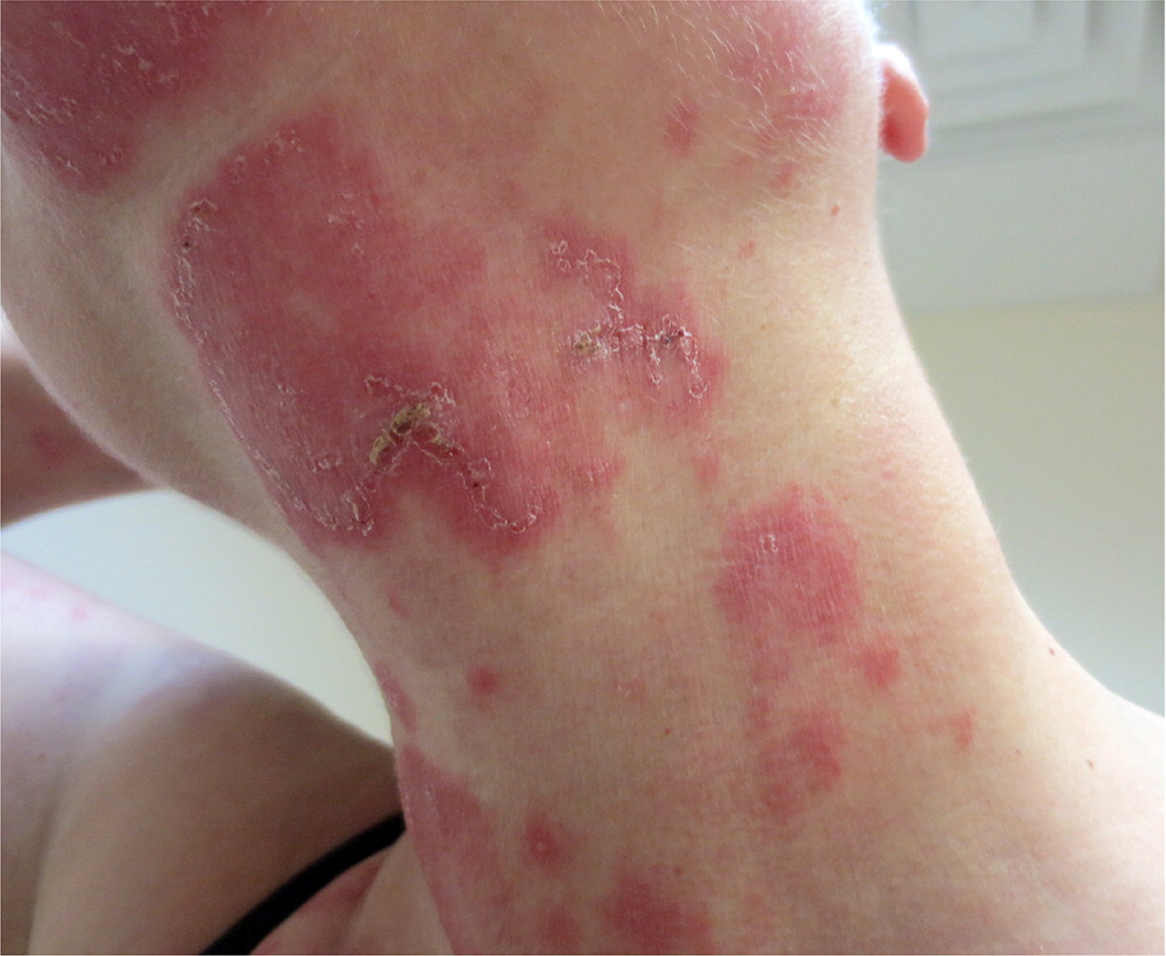 Ringworm skin rash