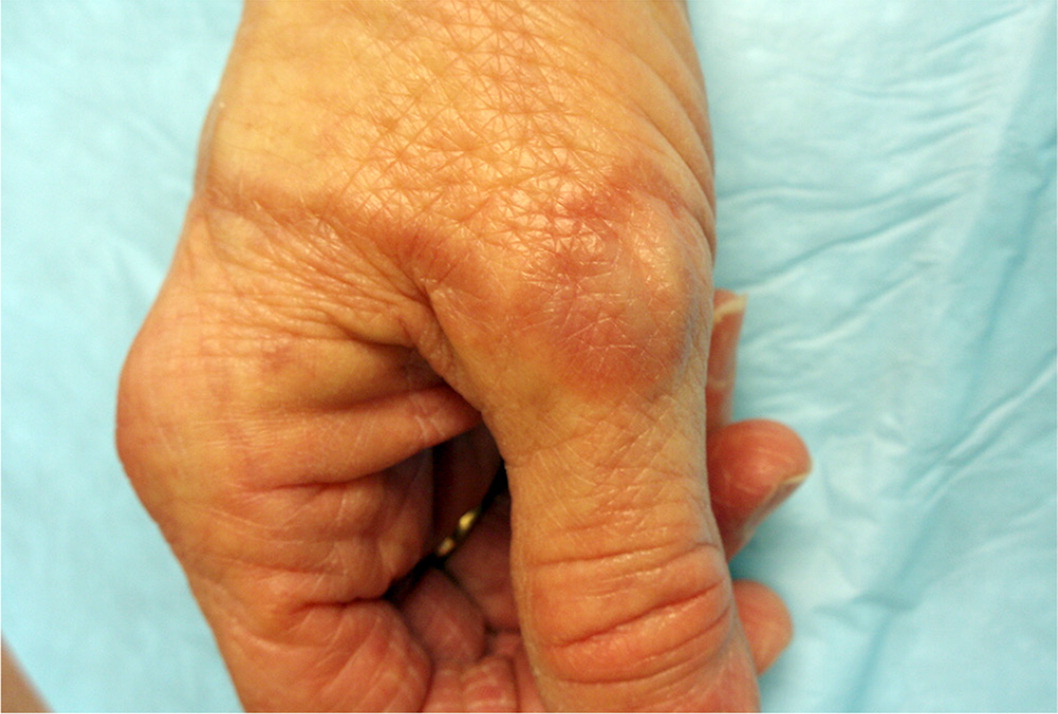 Diffuse annular lesions