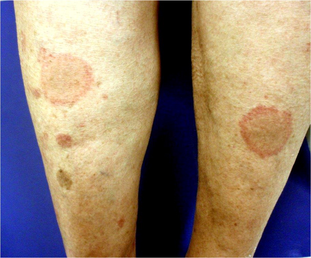 Erythema Marginatum: Causes, Picture, Treatment, and More