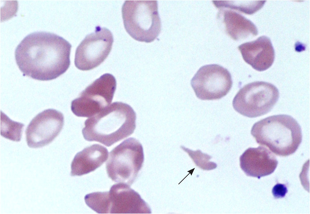 case study on hemolytic anemia