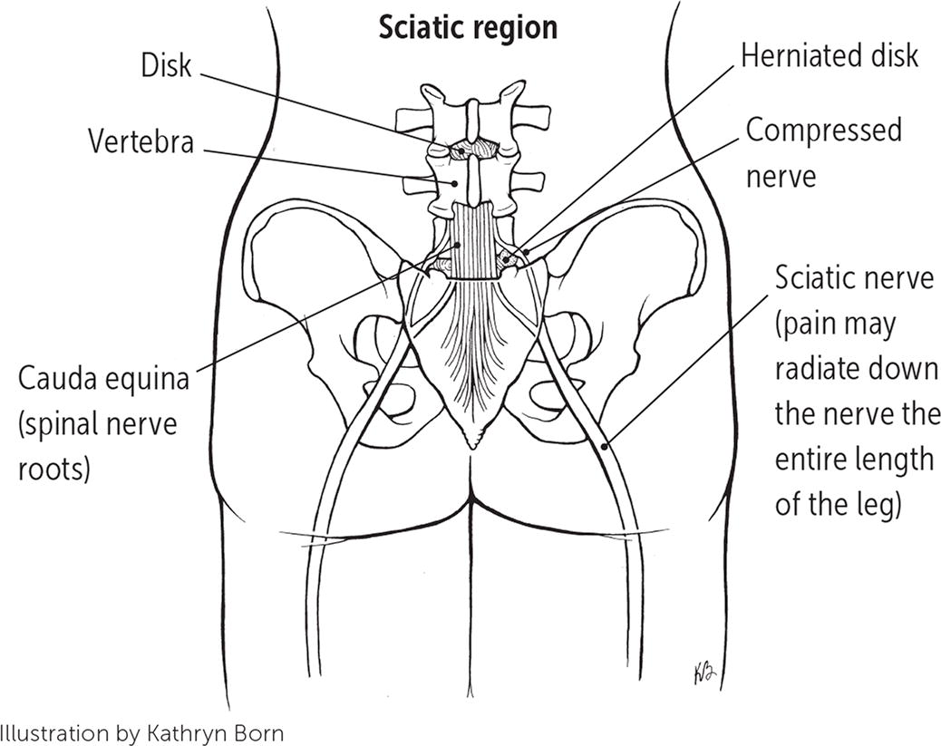 Sciatica: Overview of Low Back Pain - JOI and JOI Rehab