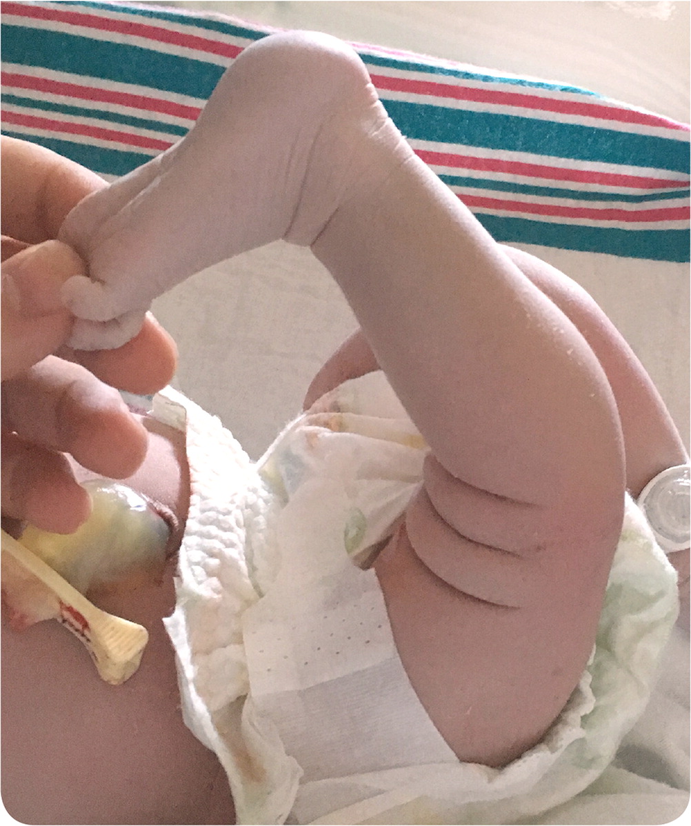 Newborn with a Hyperextended Knee AAFP