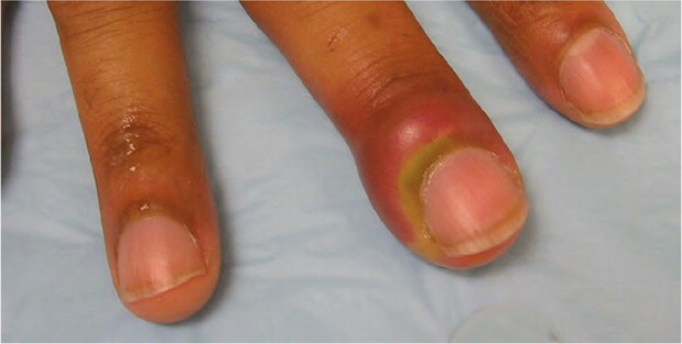 Fungal Nail Infection: Overview, Causes & Treatments
