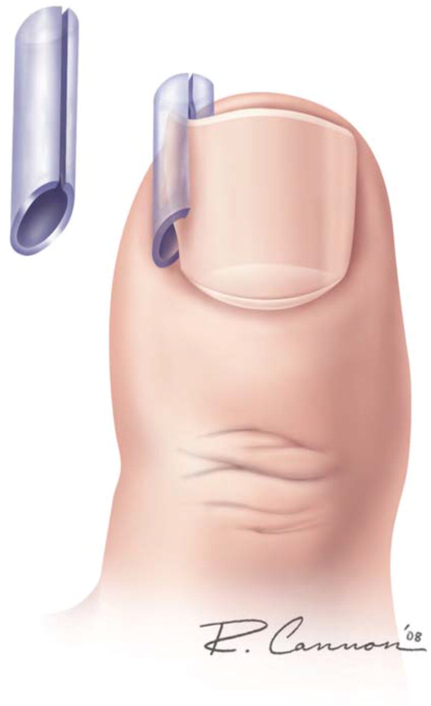 a) patient with ingrown toenail; b) V-shaped excision in the angle of... |  Download Scientific Diagram